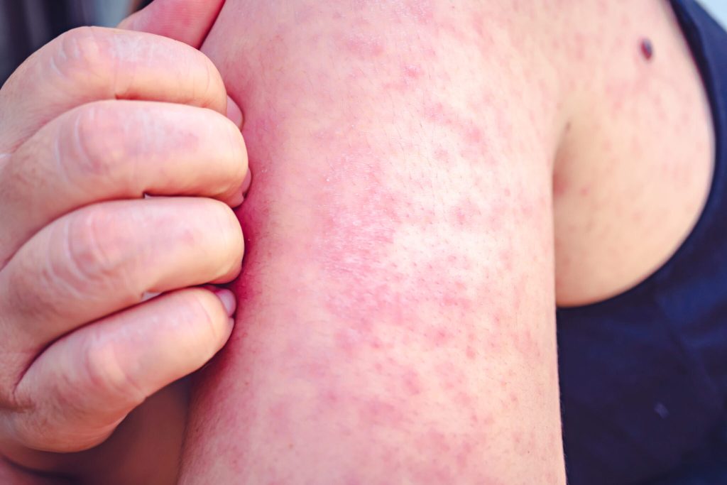 measles cases image  